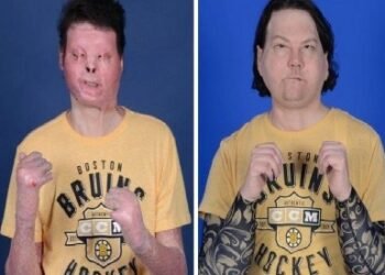 شاهد .. زراعة وجه ويدين لرجل امريكي تعرض لحادث في 2018