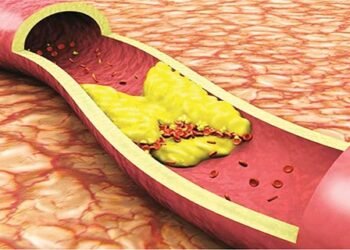 دراسة: دواء مخصص لعلاج ارتفاع الكوليسترول يقلل من الإصابة بكورونا بنسبة 70%